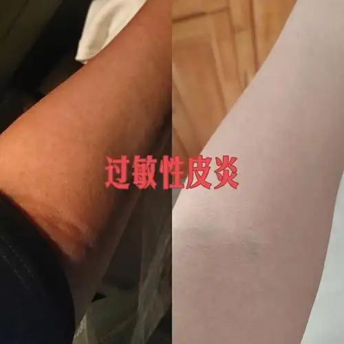 过敏性皮炎的治疗与护理