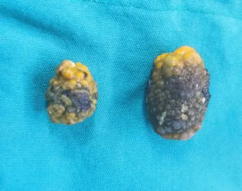 保胆取石手术术后胆结石会复发吗