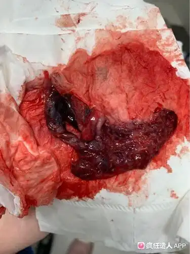 这是孕囊的一部分吗?