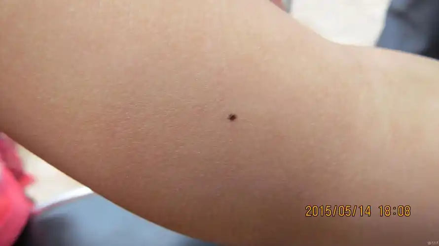 4周岁女童黑痣
