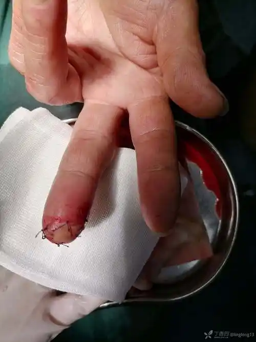 病例分享50岁男左中指尖被菜刀切伤远端游离基层医院予以原位缝合请