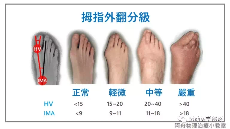 当拇指外翻角度(hv)>15度,第一脚趾和第二脚趾间角度(ima)>9度的时候