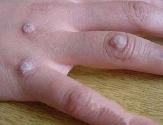 尖锐湿疣菜花初期图片