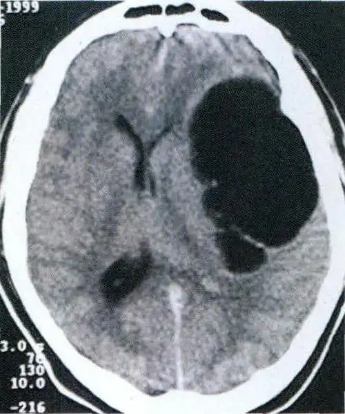(图) -1-2 左颞叶脑包虫病