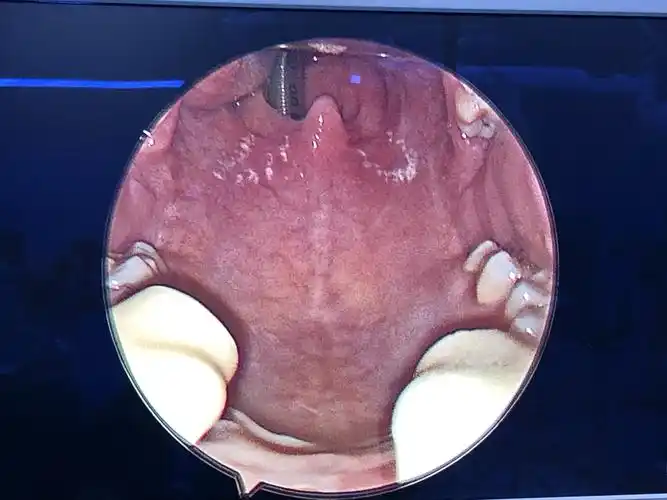 低温等离子射频消融术做鼾症(osahs)手术(改良悬雍垂腭咽成型术)的