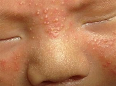 新生儿痤疮一般长在哪里?