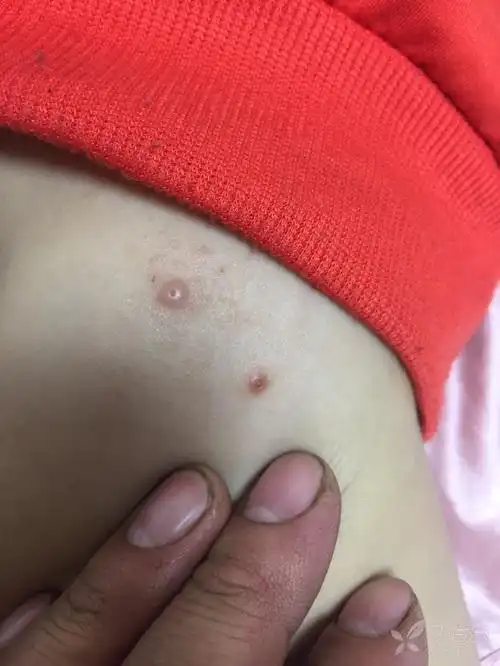 这个红色的斑点是什么 - 皮肤与性传播疾病讨论版 -丁香园论坛