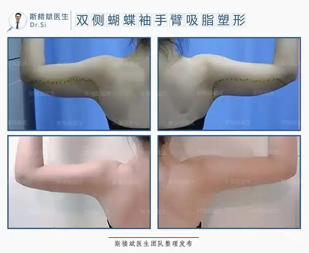 双侧蝴蝶袖手臂 !--haodf:8:xizhi--> !--haodf:8:xizhi--> !