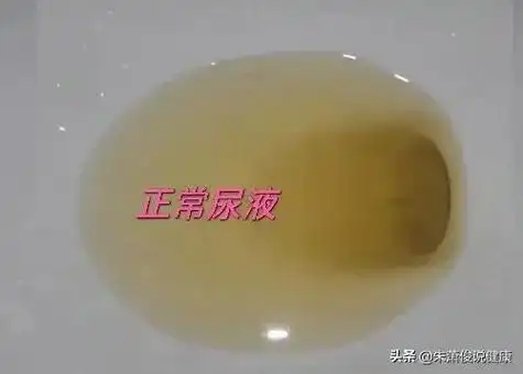 糖尿病泡沫尿为什么时有时无?