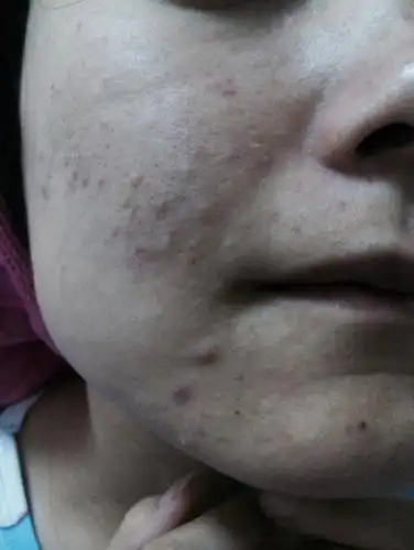 我的脸起的痘痘已经3年了,一直接连不断的起,很疼,还有脂肪粒,怎么办?