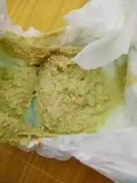 会不会是胆道闭锁?