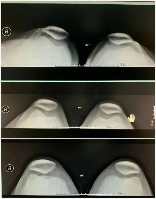 dcn放射科成功申请实用新型专利——一种髌骨轴位摄影可调角度支架