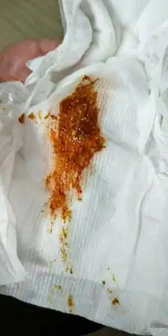 我家宝宝35天的时候也拉这样的粑粑,去医院化验大便,做ct检查,结果是