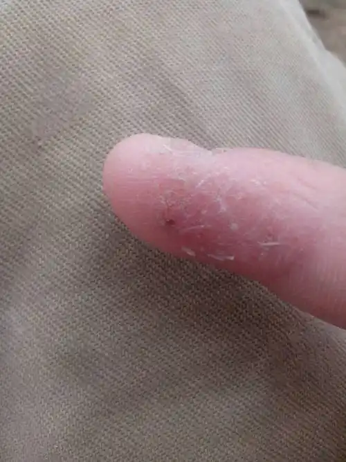 我手指上出现有白色屑片,只有一个手指头有,我怀疑是牛皮癣的初期,有