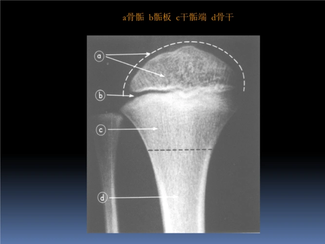 骨正x线课件.ppt