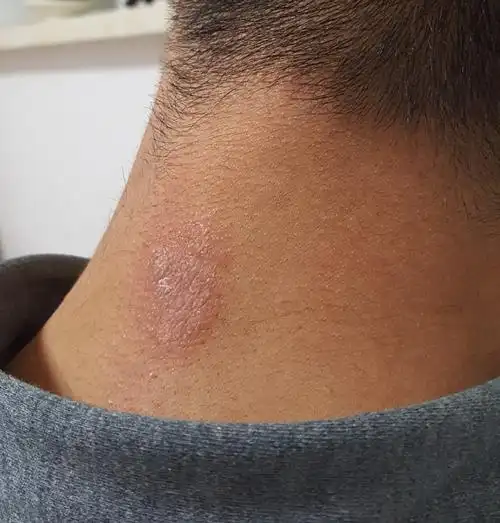 请问这是长的什么癣吗?