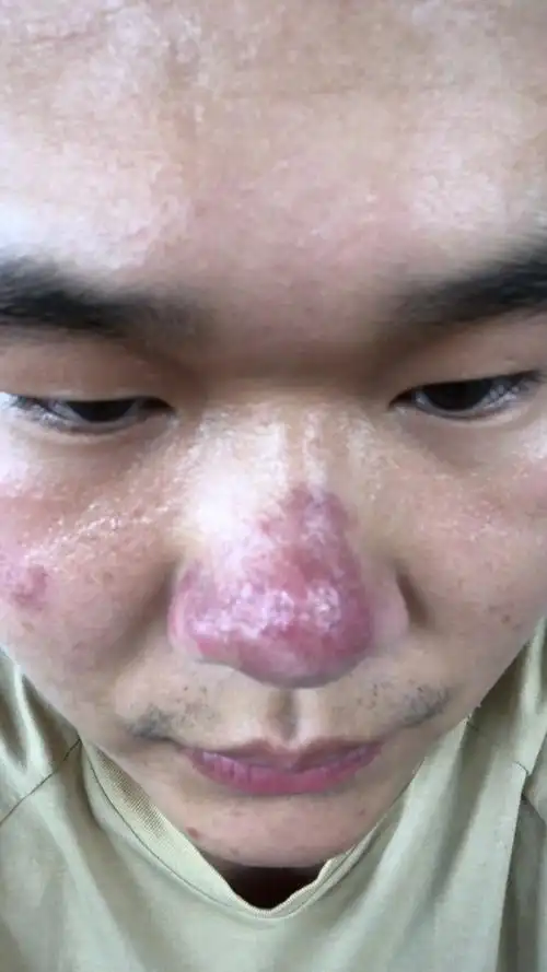 我是一个酒糟鼻患者有没有大神告诉我酒糟鼻应该怎么治疗谢谢