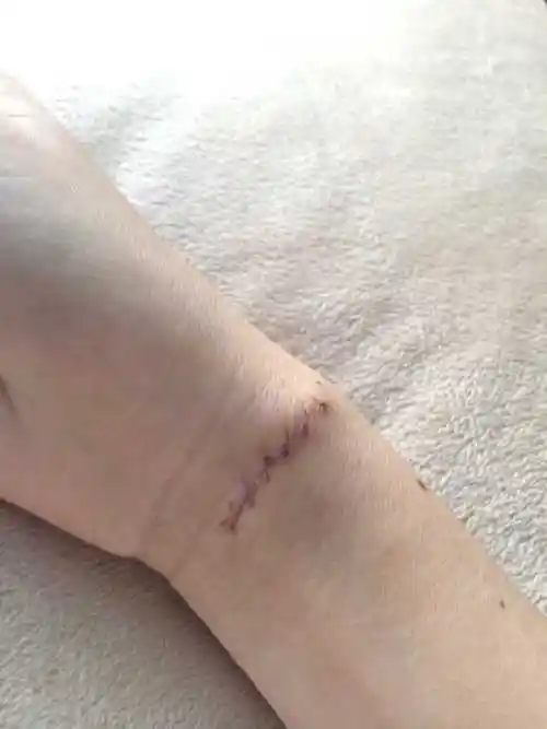 伤口拆线会很疼吗