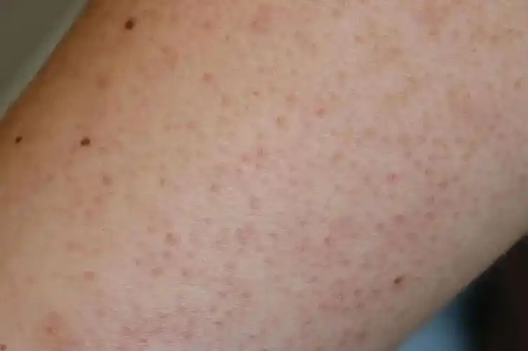 鸡皮肤是个挺形象的别名,它的学名叫「毛周角化病(keratosis pilaris