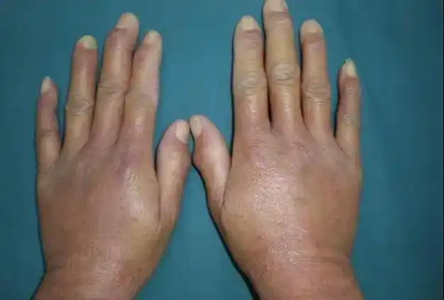 硬皮病的主要症状是什么?|治疗|性疾病|纤维化_网易订阅