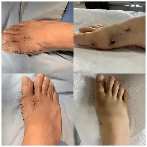 靖江市人民医院手足外科成功开展靖江首例拇外翻微创矫形术(mica)