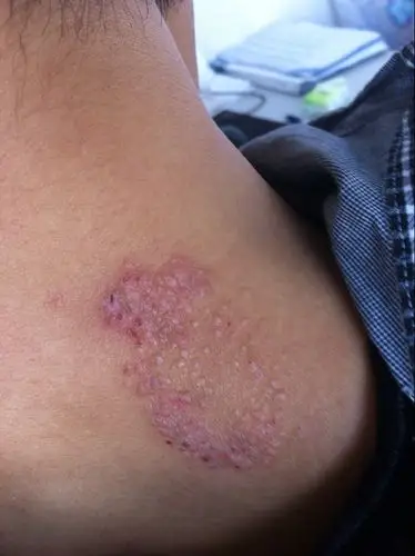 这是什么皮肤病,发现时硬币大小,用手抠过,越扣越大,是什么皮肤病