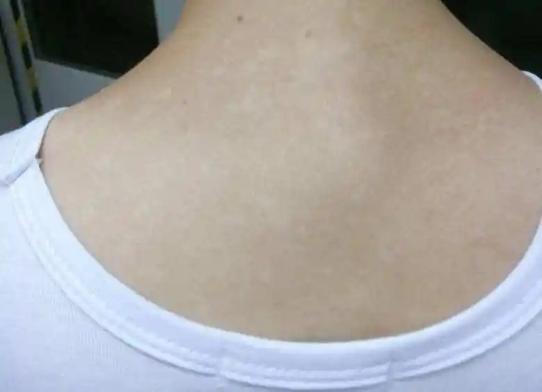 注意:夏季白斑≠白癜风,别把汗斑错当白癜风