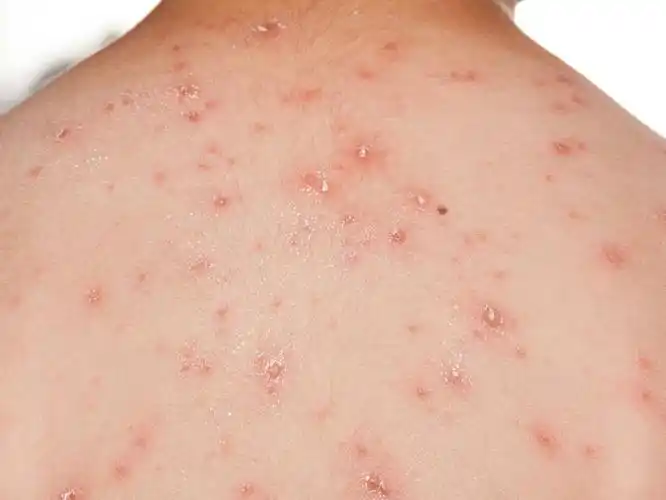 水痘的初期症状有哪些?水痘传染期多久?