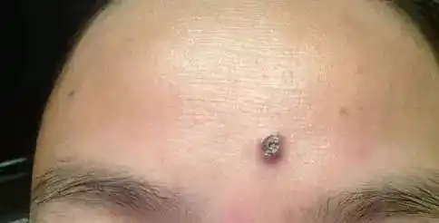 小腿长颗痣,没想到3个月后竟变成这么可怕…医生也惊呆了!