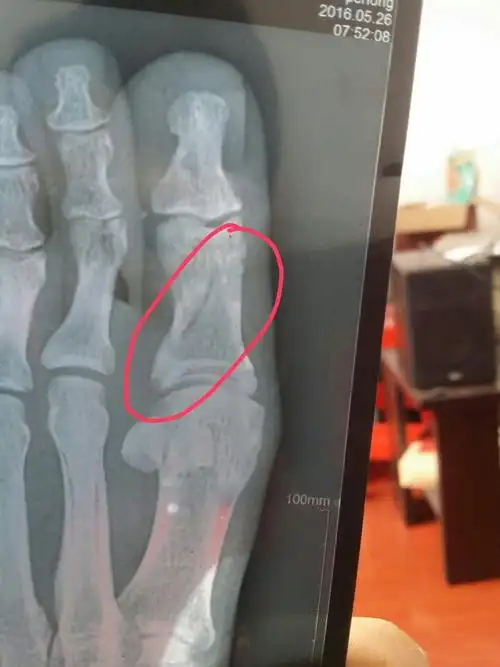 这个属于骨裂还是骨折,不打石膏可以吗