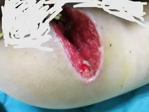 1月12日发现左边屁股特别疼,肿的坐不下去,鉴于老公得过肛周脓肿,赶紧