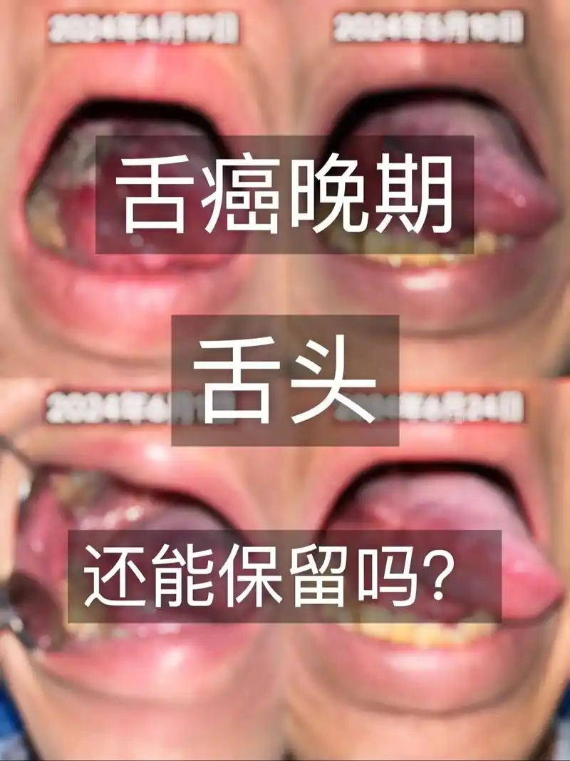 舌癌晚期,舌头还能保留吗?#器官保留 #医学科普 #槟榔致癌 - 抖音