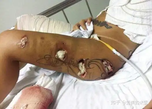 原因还是医生手术无菌操作不严格或者是自己术后卫生不到位造成了感染