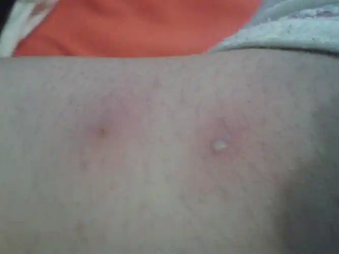 阴茎长毛囊炎的症状图片