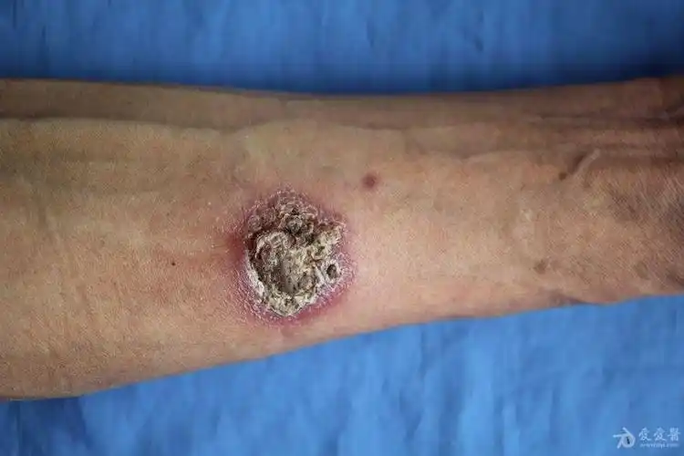 典型病例欣赏——孢子丝菌病3 - 皮肤及性传播疾病讨论版 - 爱爱医