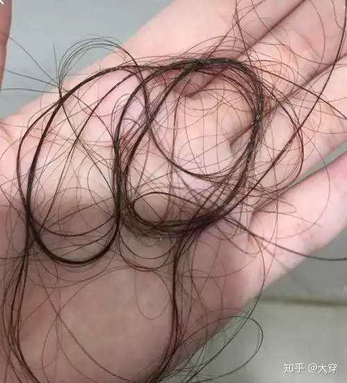 有什么治疗脱发亲测有效的方法?