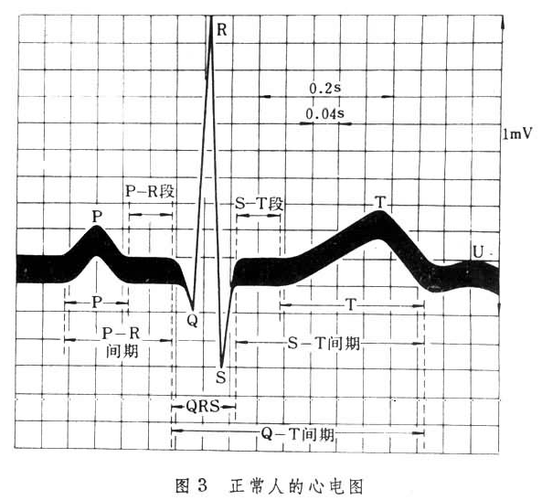 窦氏心率患者可以打羽毛球吗