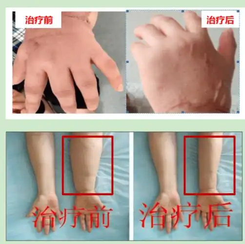 淄博市第一医院淋巴水肿门诊开诊了