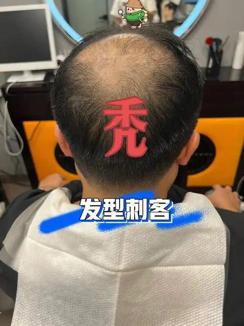广州千丝引假发  #秃头  #假发  #假发片  #男士假发定制  #男士发型