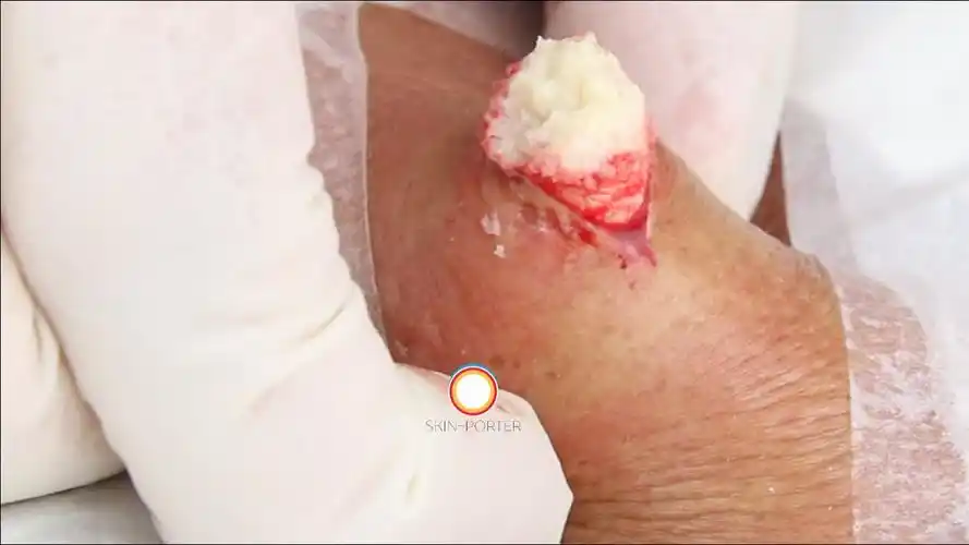 back sebaceous cyst extraction and incision.