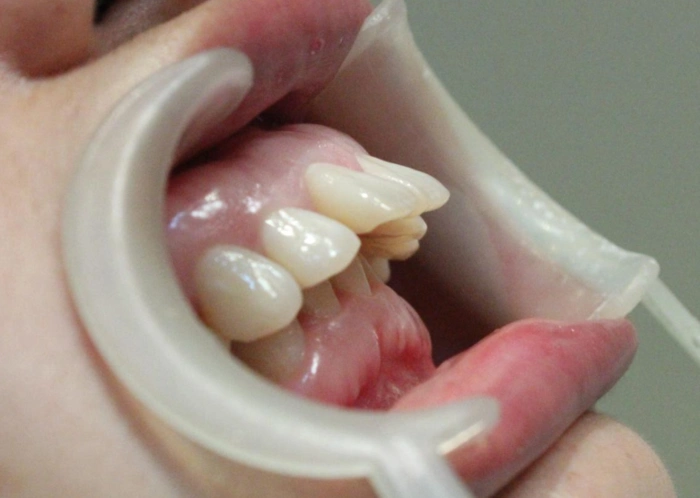 上排前牙牙齿前突,也叫龅牙,可能是因为上牙弓或上颌前突,也可能是下