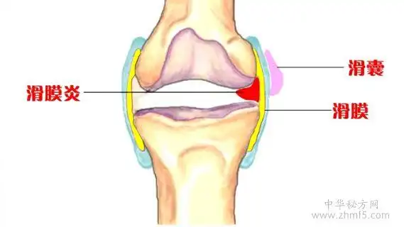 滑囊炎的治疗方法-祖传特效偏方治疗滑囊炎