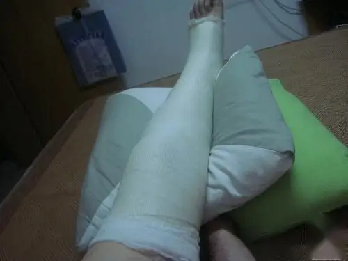 髌骨骨折可以打石膏吗