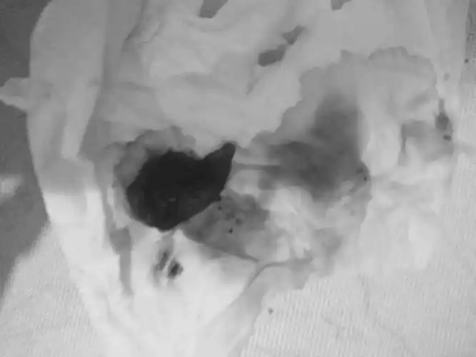 你好我宫颈锥切后第八天出血找医生检查了,医生给我止血了又用了止血