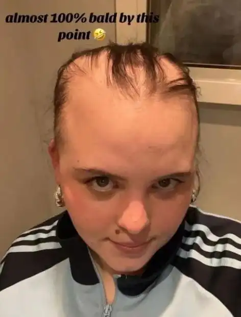 美女妹子连中新冠8次秃成光头, 华人集体破防 ,狂掉4个月头发