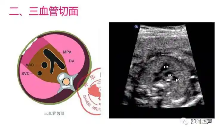 胎儿心脏检查常见切面图