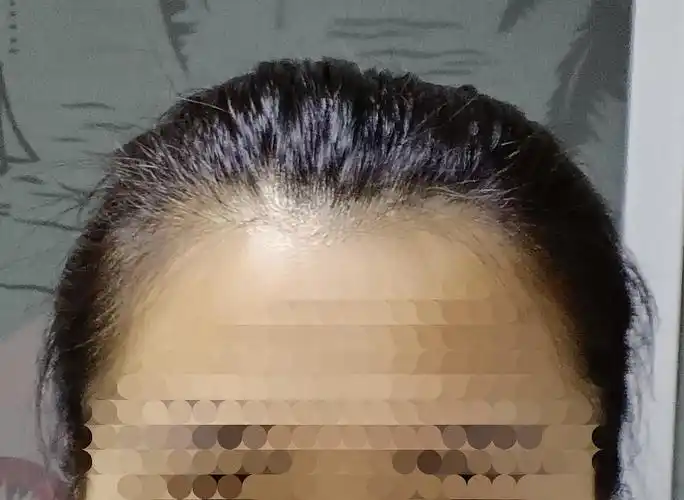 标题:姐妹们,帮我看一下,我扎马尾不好看的原因是不是因为颅顶低