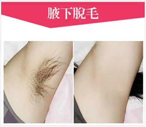 而激光脱毛技术去除比基尼毛就是一种最好的去除隐秘部位的毛发的方法