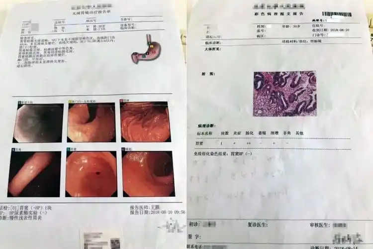 检查诊断:                              慢性浅表性胃炎