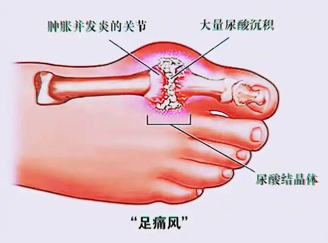 【医学科普】痛中之痛:痛风